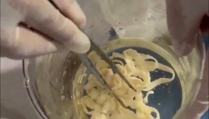 女子体内排出10米长绦虫！原是两年前旅游时吃了这种食物