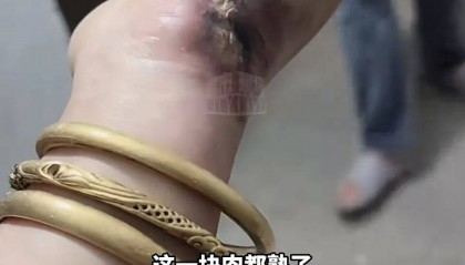 一瞬间手被烧熟，金手镯被电碎！女子给电动车充电，不慎碰到充电口受伤