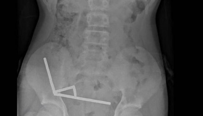 腹痛4天后送医，新西兰男孩吞下约100颗磁铁致肠道坏死 医生切除部分肠组织