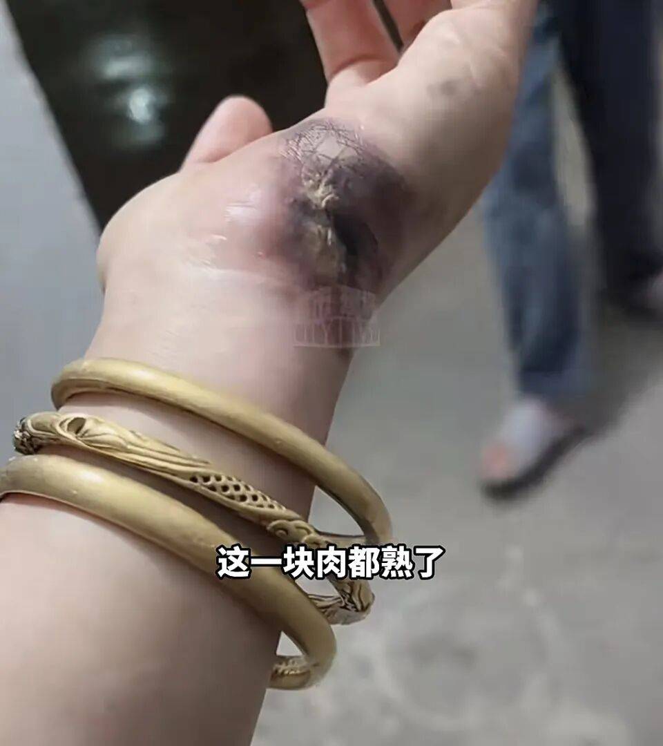 一瞬间手被烧熟，金手镯被电碎！女子给电动车充电，不慎碰到充电口受伤